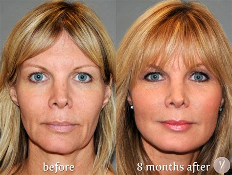 Facelift Surgery: 5 Useful and Significant facts