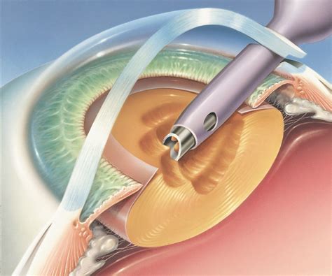 Cataract Surgery1 (2) - Applecross Eye Clinic