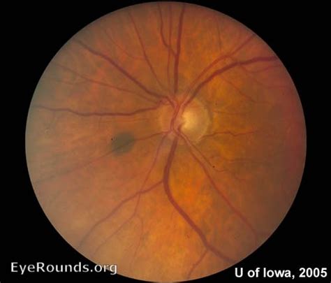 Atlas Entry - Choroidal Nevus