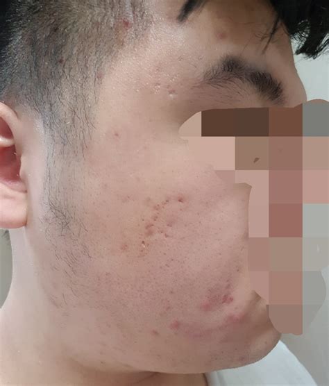 [Skin Concerns] Is this acne or another thing and how can I treat it. : SkincareAddiction