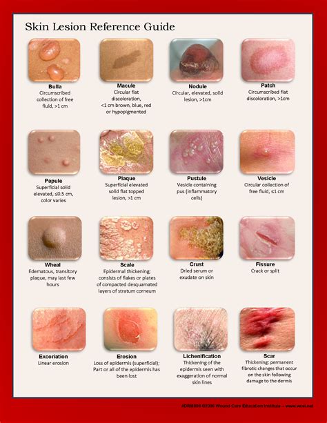 Types Skin Lesion Chart