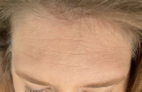 What Are These Tiny Bumps On Forehead? : r/DermatologyQuestions