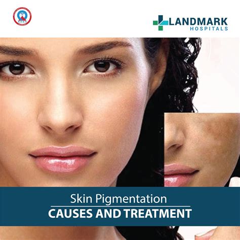 Skin Pigmentation Causes And Treatment – Landmark Hospitals