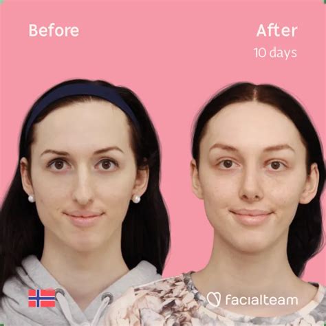 Facial Feminization Surgery Results — Facialteam