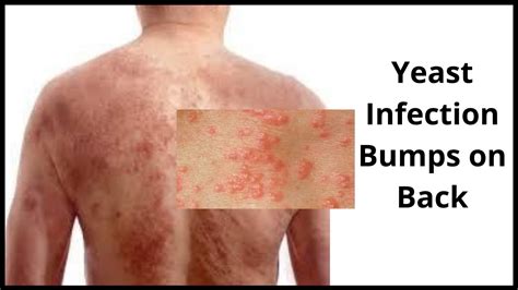 Yeast Infection Bumps: Causes, Symptoms, Treatment & Cure.