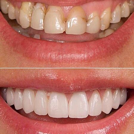 Before and after Smile design, Veneers - Susana Moya Dental y Esthetic ...