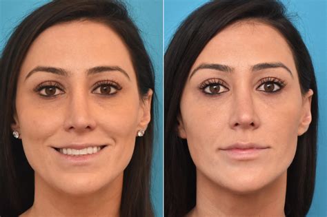 Injectable Fillers photos | Philadelphia, PA | Patient 75