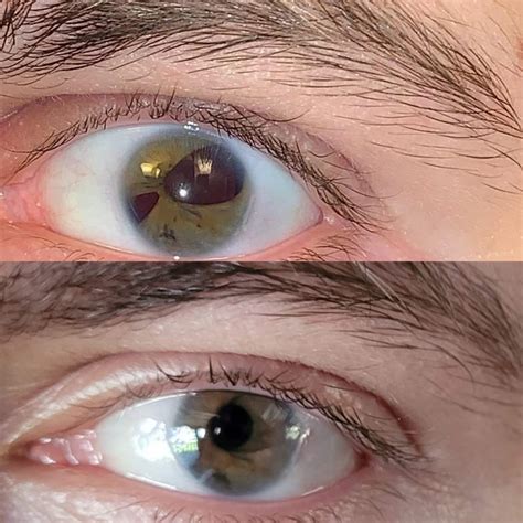 Brother's eye post synthetic iris replacement (and underlying cataracts) : r/interestingasfuck