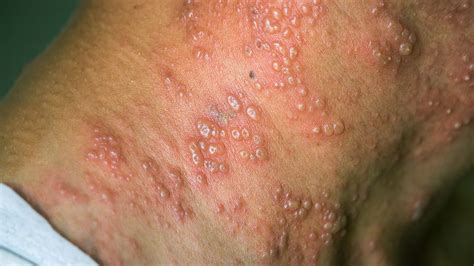 Is It Shingles Virus or Something Else? | Everyday Health