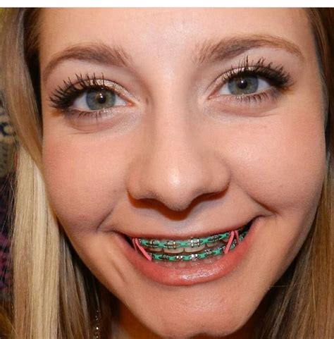 what are nice colors for braces - Out-Of-This-World Blogs Ajax