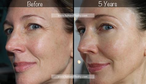 5-Year Retin-A Results ~ Before & After for Wrinkles & Anti-Aging – hotandflashy.com