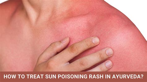 How to Treat Sun Poisoning Rash in Ayurveda?