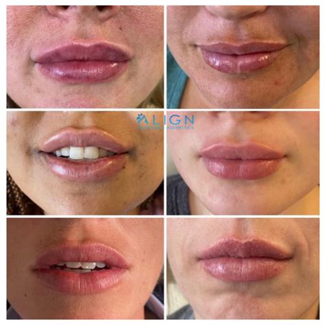 Lip Filler Kinds Permanent and semipermanent fillers while tempting are not