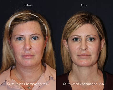 Advanced Radio Frequency Skin Tightening and Lifting Gallery - Dr. Jason Champagne