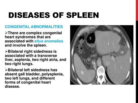 Diseases of spleen