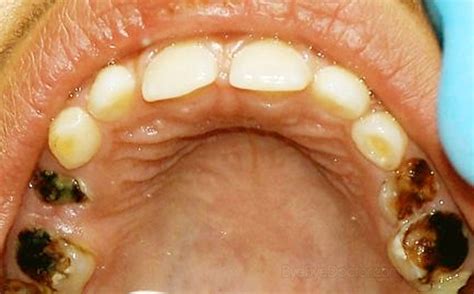 Tooth Decay - Pictures, Treatment, Symptoms, Causes