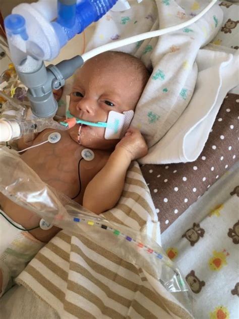 Baby with Trisomy 18 denied life-saving surgery by insurance company