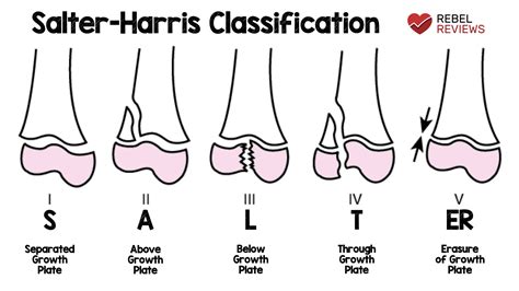 Salter-Harris Fracture Classification - REBEL EM - Emergency Medicine Blog