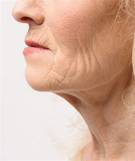 Wrinkles | Dr Grace Kelly Aesthetics Clinic | Buckinghamshire