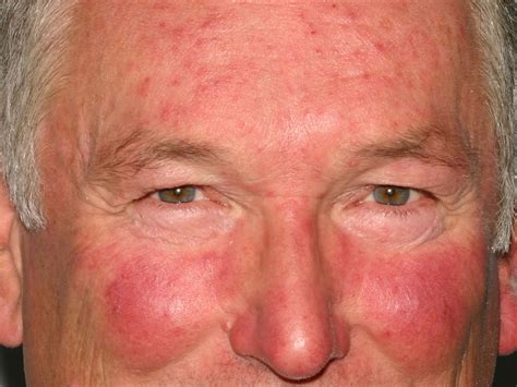 Rosacea - Causes, Symptoms, Cream, Diet & Rosacea Treatment