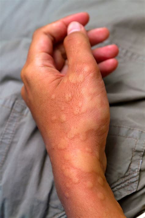 Hives - Simpson Allergy and Asthma