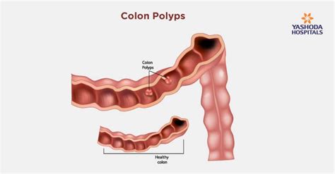 Colon polyps: Causes, Symptoms, Diagnosis and Treatment