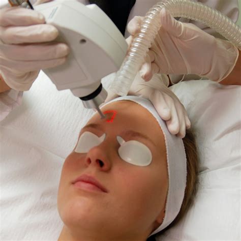 Does Laser Treatment for Acne Work?