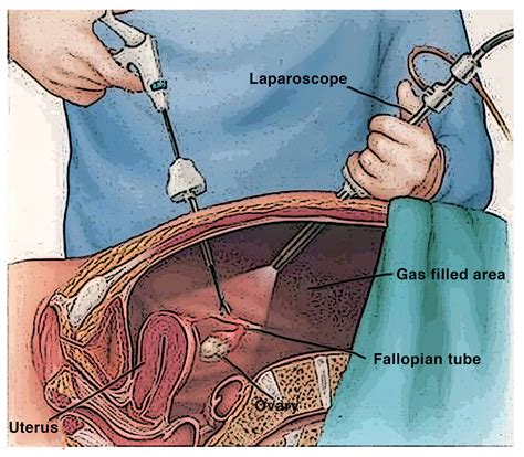 Laparoscopic Surgery for Endometriosis - Statesboro Women's Health ...