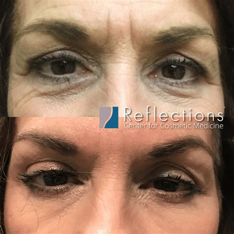 Botox for Under Eye Wrinkles & Frown Lines Before & After Photos New Jersey - Reflections Center