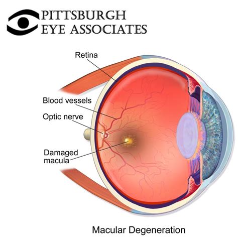 Macular Degeneration - Pittsburgh Eye Associates