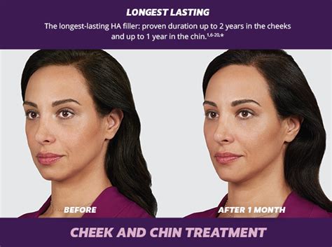 Juvederm Voluma Chin and Cheek Augmentation Cleveland Ohio | Cleveland Facial Plastic Surgeon