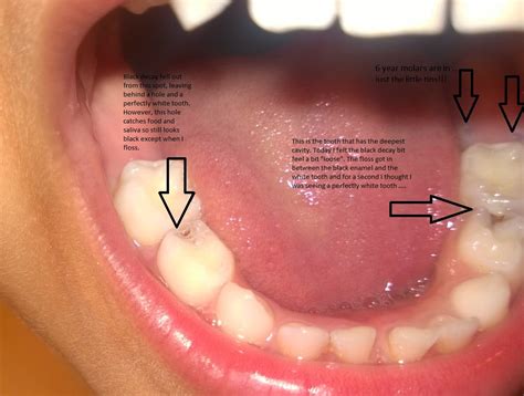 My attempt to remineralize teeth: First permanent tooth is in ... and is the premolar getting ...