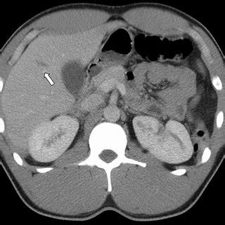 ct Scan taken acutely showing 3.4 × 1.5 cm nonperforating liver laceration. | Download ...