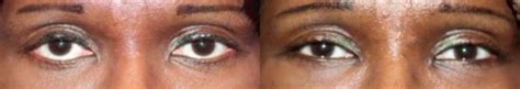 Dr. Prasad, New York, New York Reducing Scleral Show From Lower Eyelid Retraction » Eyelid ...