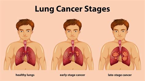 A complete guide to learn everything about lung cancer - Yashoda Hospital