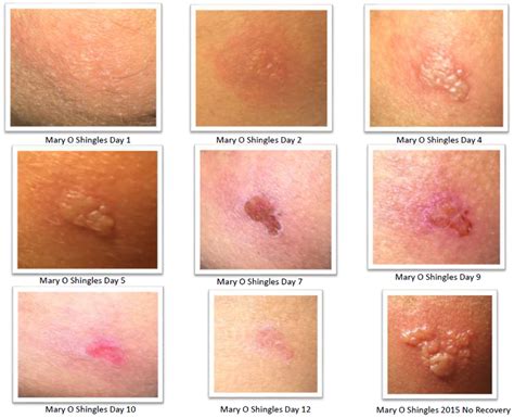 Review-Shingles-MO - NeoGenesis UK Pro