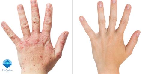 What is Eczema and How Can Phototherapy Help? - Skin Matters Bristol