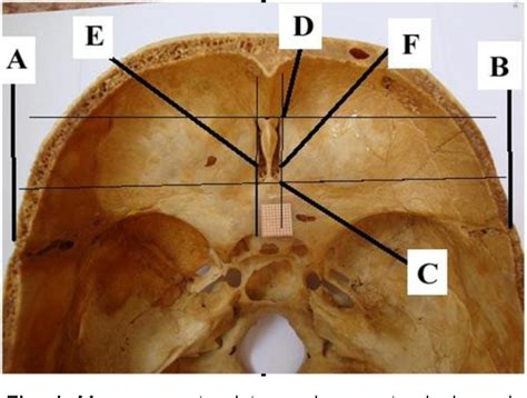 Figure 1 from Anatomy of the adult foramen caecum | Semantic Scholar