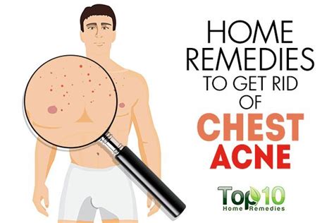 Home Remedies to Get Rid of Chest Acne | Top 10 Home Remedies