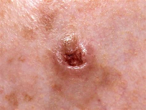 Pictures Of Different Types Of Skin Cancer – the meta pictures