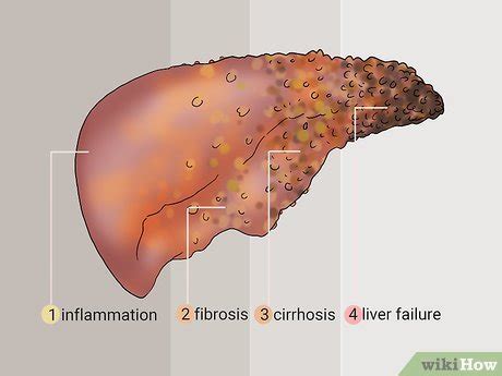 How to Diagnose Liver Fibrosis