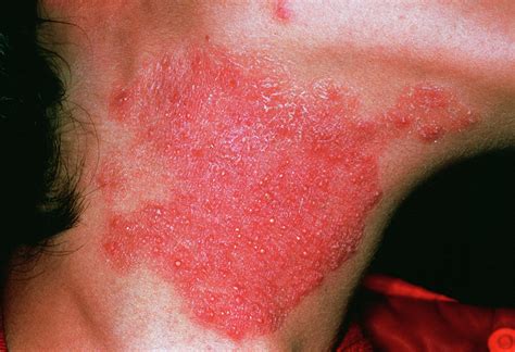 Fungal Skin Infections