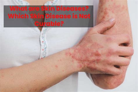 What are Skin Diseases? Which Skin Disease is Not Curable?