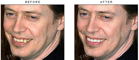 38+ Steve Buscemi Teeth Fixed Pics - Cante Gallery