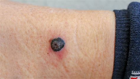 Early Stage Melanoma Pictures