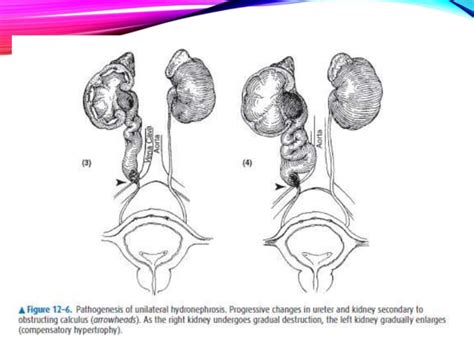 Hydronephrosis and Pyonephrosis