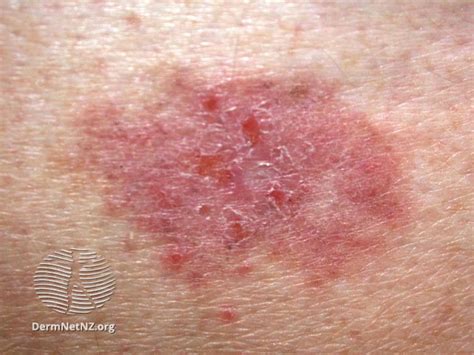 File:Basal cell carcinoma, leg (DermNet NZ bcc-leg-12-dn).jpg - NC Commons