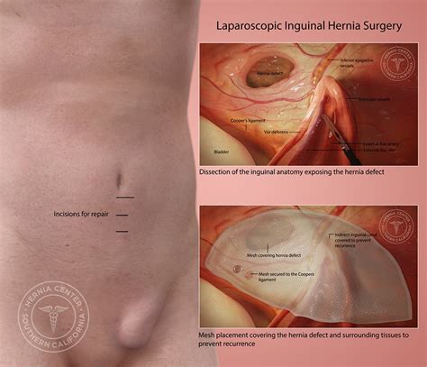 Inguinal Hernia Repair Los Angeles Pasadena Orange County CA