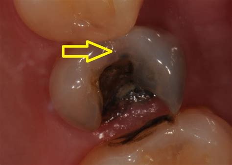 What are My Options to Repair a Cracked Tooth?