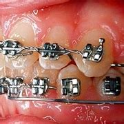 Braces Experience